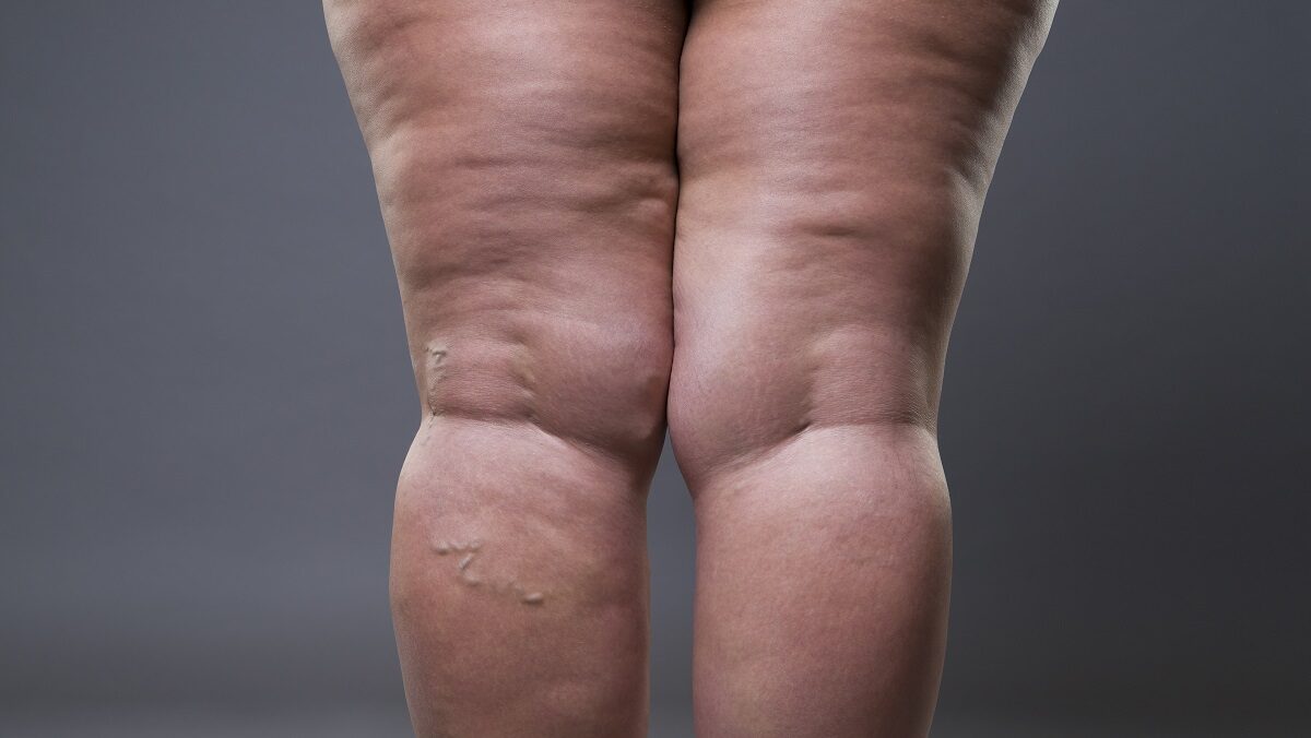 Imagem ilustrativa: acúmulo desproporcional de gordura nas pernas, padrão característico do lipedema